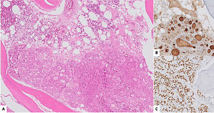 Metastasis of oncocytic thyroid carcinoma in the mandibular condyle: An exceptional localization.