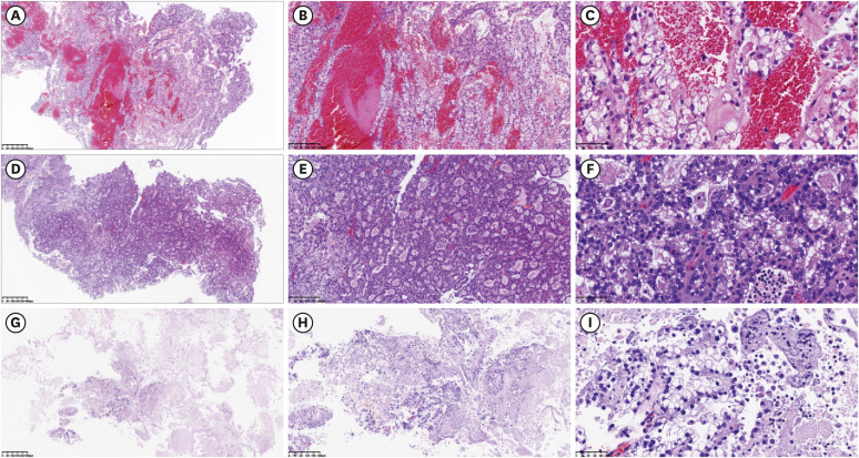 Humanized patient-derived xenograft mouse model bearing ovarian clear cell carcinoma.