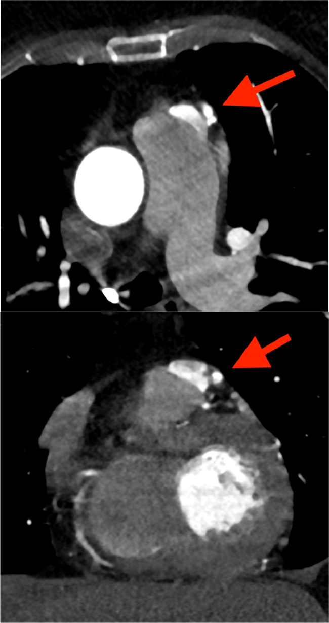 Fistula Between the Left Anterior Descending Artery and the Pulmonary Trunk.