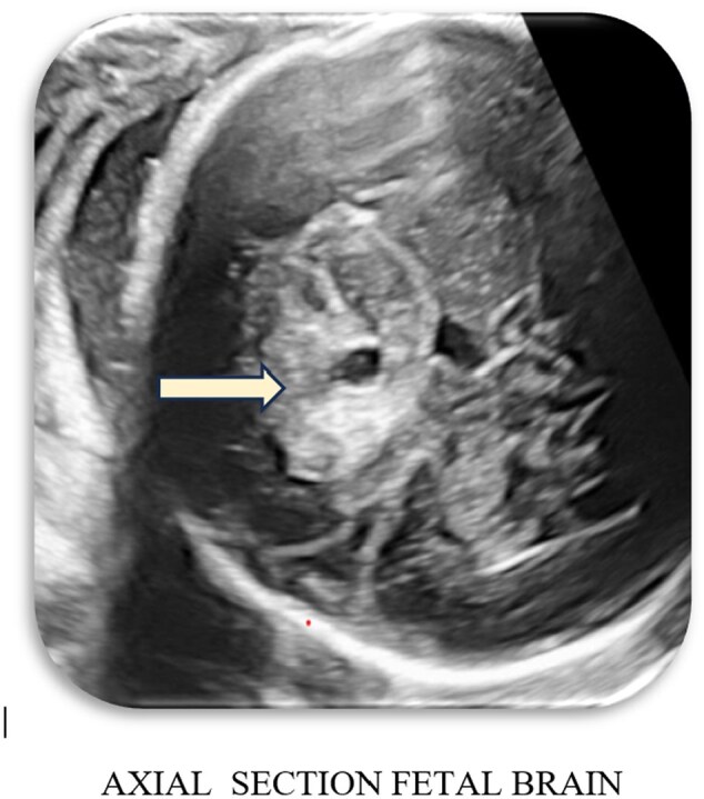 Unravelling fetal enigmas: a case of suprasellar lesion.