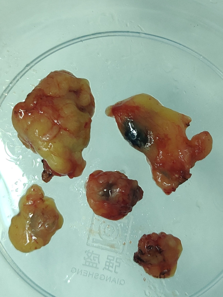 Risk of Residual Axillary Lymph Node Macrometastasis in Early Breast Cancer PATIENTS with One Positive Macrometastasis Sentinel Lymph Node.