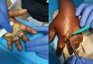 A hard-to-heal wound: a case study on the collaboration between nonprofit and Public Health Sector in Southern Italy.