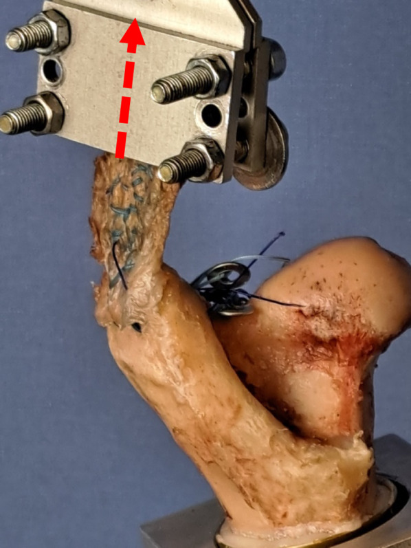 A novel augmentation technique for the repair of full thickness gluteal tendon tears: a biomechanical analysis in an ovine model.