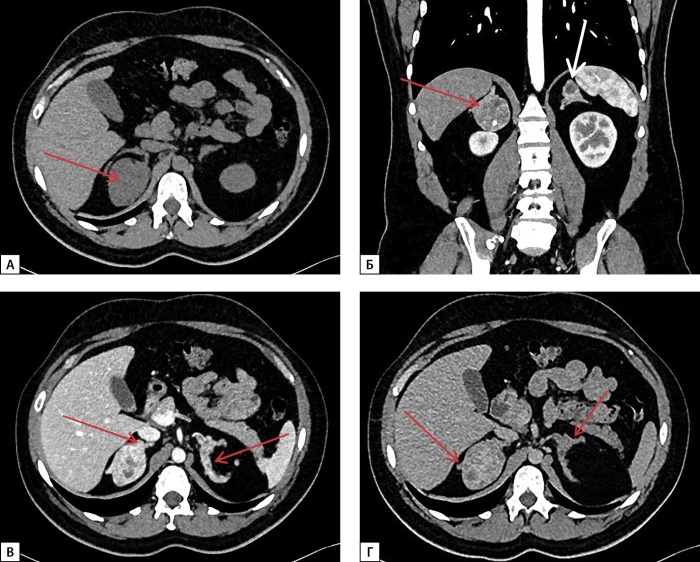 [Difficulty with differential diagnosis on adrenal lesions in congenital adrenal cortex dysfunction: a series of clinical cases].