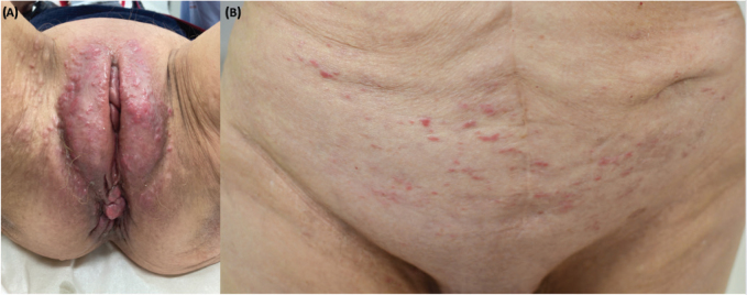 Coalescing Papules on the Pubis in an Ovarian Carcinoma: A Quiz.