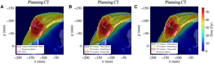 A unified workflow for classifying patterns of locoregional failure using radiotherapy treatment planning dose distributions.
