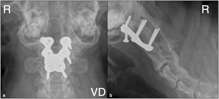 Ventral fixation and dorsal decompression of a complex occipitoatlantoaxial malformation using a custom-made plate in a cat.