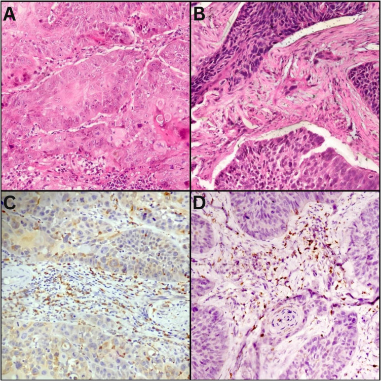 Role of Intratumoural Budding and Its Association with Tumour-Associated Macrophages in Preoperative Biopsies of Oral Squamous Cell Carcinoma.