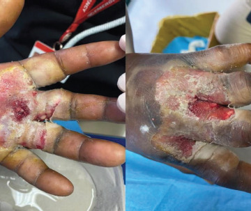 A hard-to-heal wound: a case study on the collaboration between nonprofit and Public Health Sector in Southern Italy.