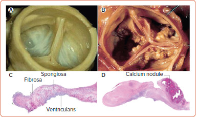Aortic Valve Calcium: A Narrative Review of its Role in the Assessment of Aortic Stenosis and as a Predictor of Post-transcatheter Aortic Valve Implantation Outcomes.