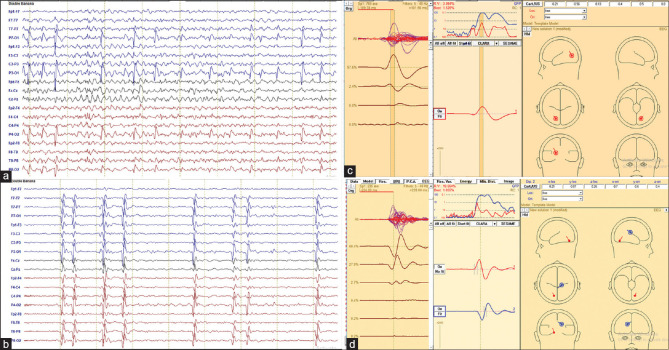 Clinical and Electrical Evolution of "Pseudo" Spike-Wave Activation in Sleep EEG Patterns in Self-Limited Childhood Epilepsies.