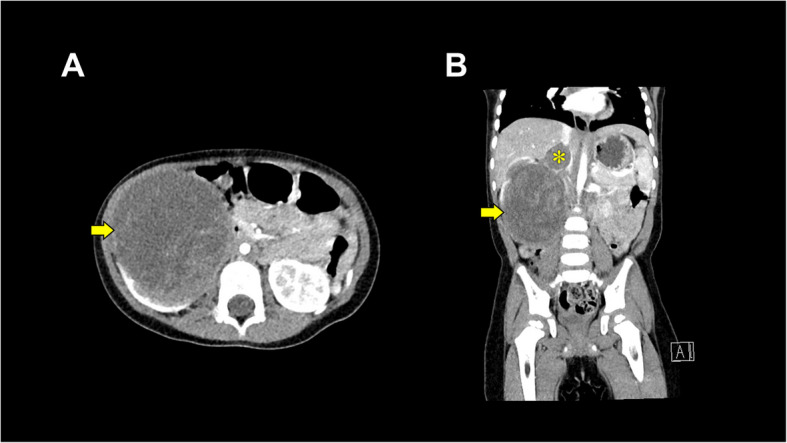 Effective management of acute hemorrhage using an SL One<sup>®</sup> rapid infusion device in a pediatric patient undergoing nephrectomy for Wilms tumor with inferior vena cava extension: a case report.