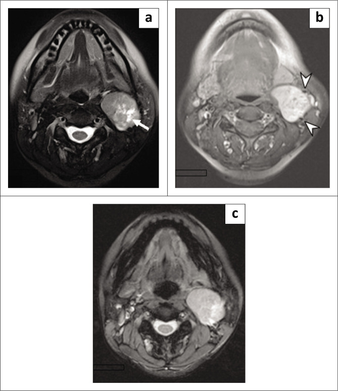 Lyre sign - Where schwannoma mimics a carotid body tumour.