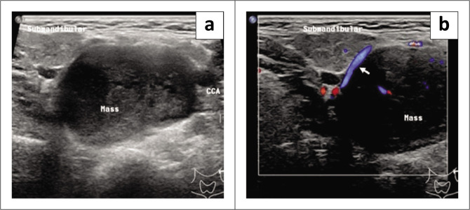 Lyre sign - Where schwannoma mimics a carotid body tumour.