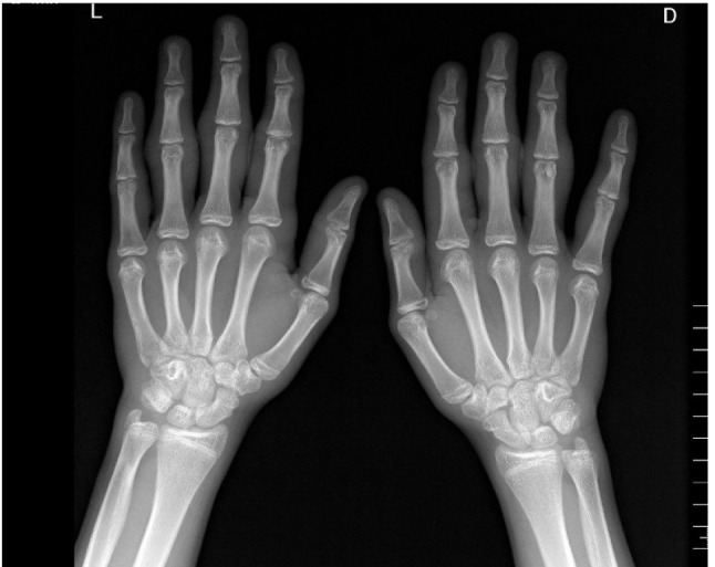 Pachydermodactily - the great imitator of arthritis: a case series.
