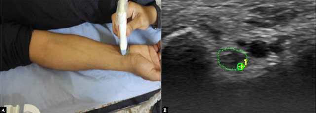 Point-of-care ultrasound: a viable alternative for assessing ulnar neuropathy in rheumatoid arthritis?