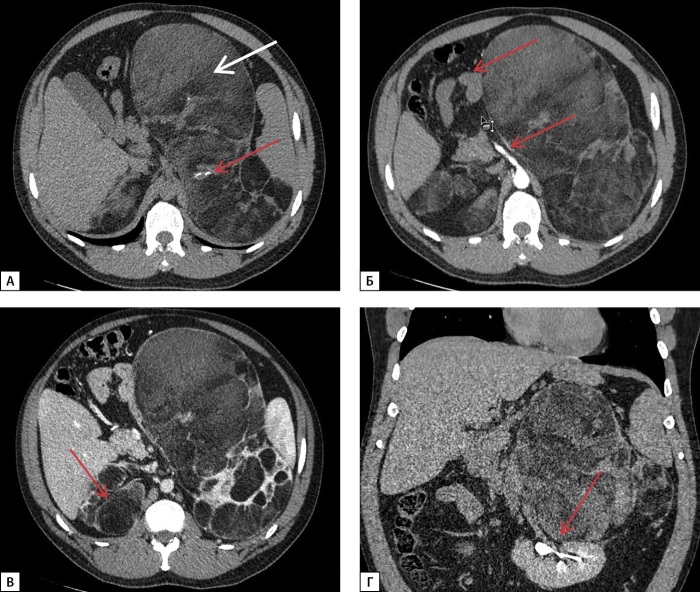 [Difficulty with differential diagnosis on adrenal lesions in congenital adrenal cortex dysfunction: a series of clinical cases].
