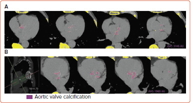 Aortic Valve Calcium: A Narrative Review of its Role in the Assessment of Aortic Stenosis and as a Predictor of Post-transcatheter Aortic Valve Implantation Outcomes.
