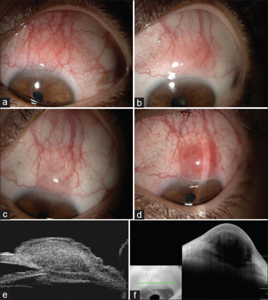 Rosai-Dorfman disease presenting as a scleral nodule in a female with multisystem inflammatory syndrome post-COVID-19 infection.