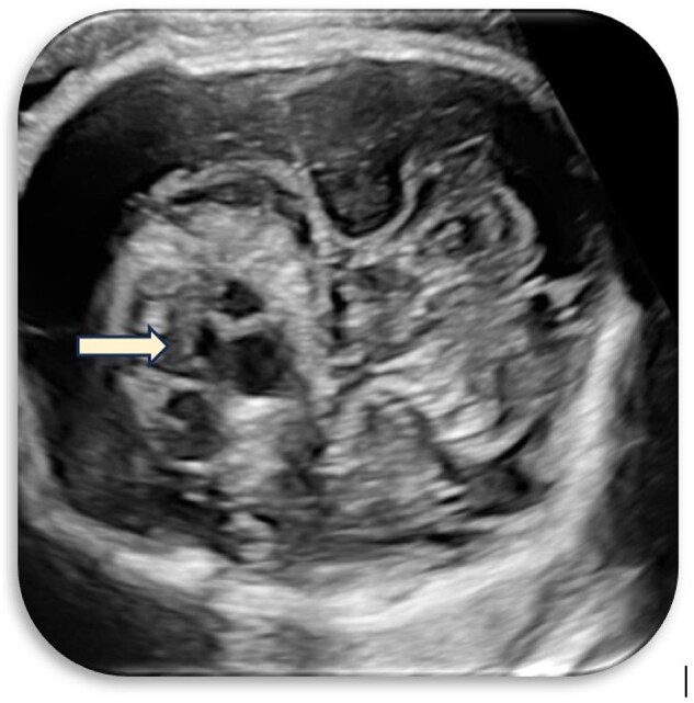 Unravelling fetal enigmas: a case of suprasellar lesion.