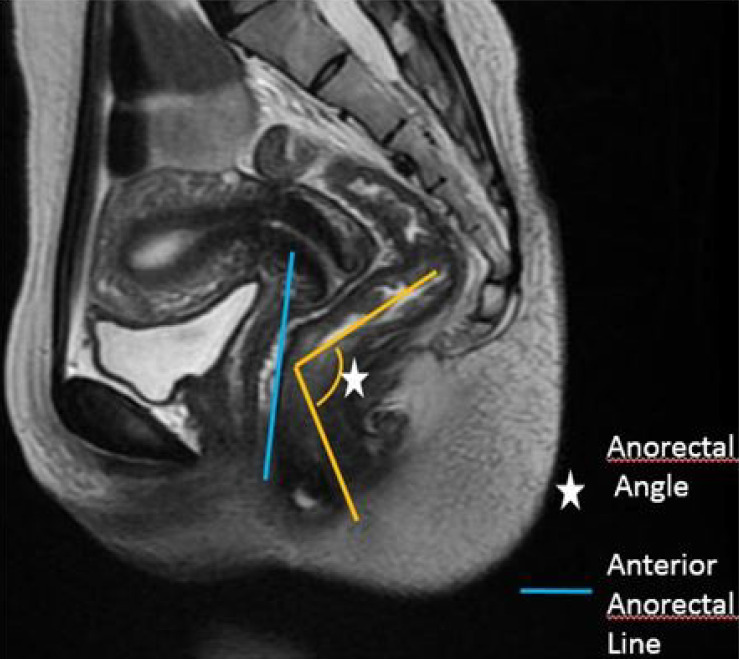 Magnetic resonance defecography assessment of obstructed defecation syndrome in patients with chronic constipation in a tertiary care hospital.
