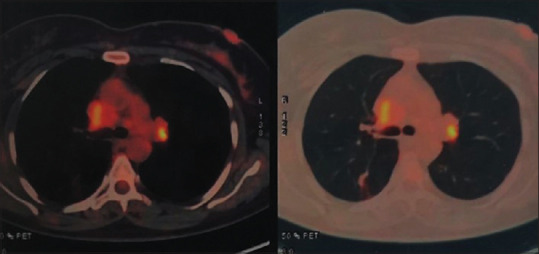 Histoplasmosis presenting as fibrosing mediastinitis and superior vena cava obstruction.