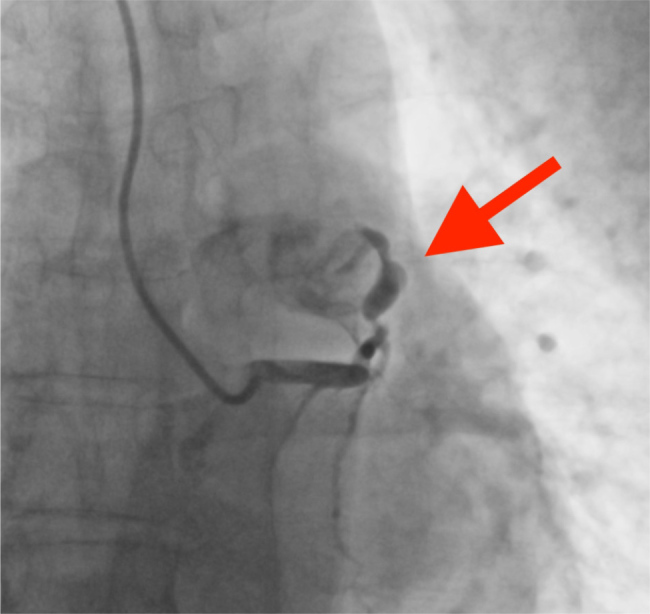 Fistula Between the Left Anterior Descending Artery and the Pulmonary Trunk.