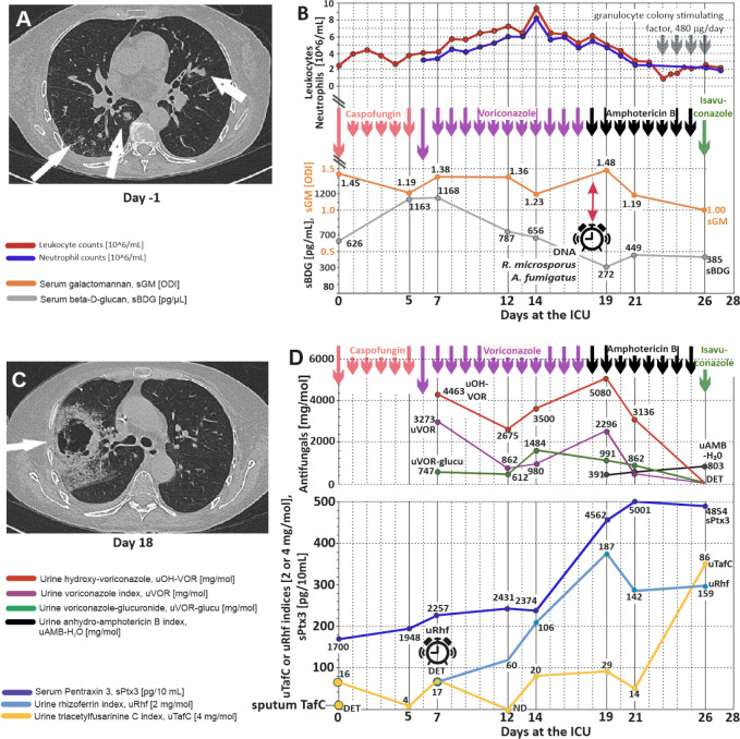 Detection of Siderophores as a Superior Noninvasive Diagnostic Tool in Unraveling Mixed Fungal Infections.