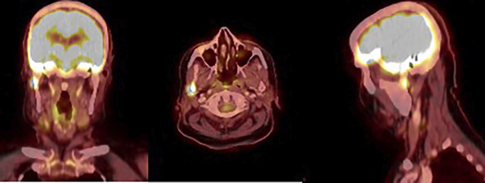 Metastasis of oncocytic thyroid carcinoma in the mandibular condyle: An exceptional localization.