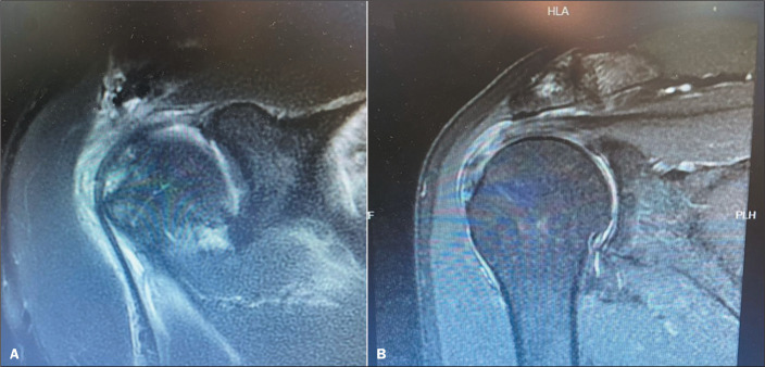Analysis of the incidence of false-negative results for SLAP lesions on magnetic resonance imaging.