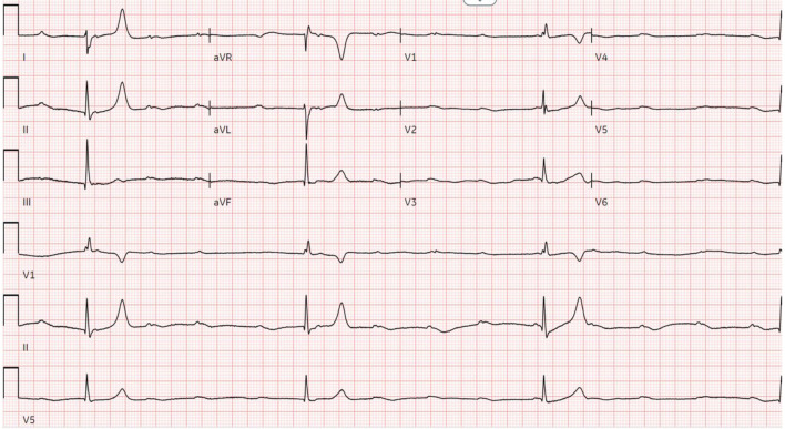 Lacosamide-Induced Complete Heart Block in a Healthy Young Female.