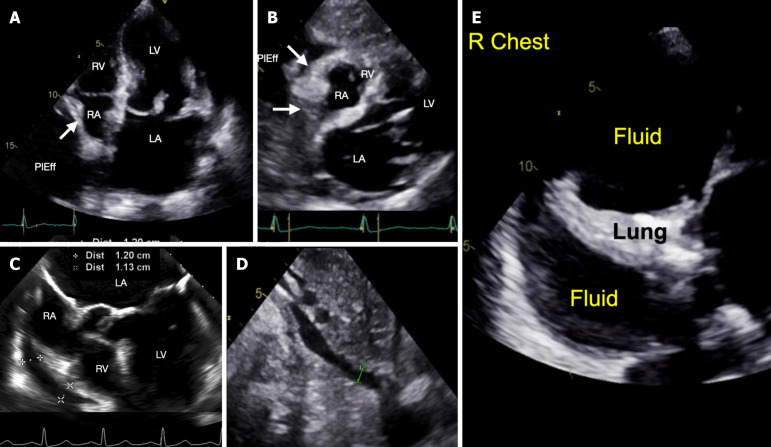 Low-pressure tamponade due to hemothorax after transcatheter edge-to-edge repair of the mitral valve.
