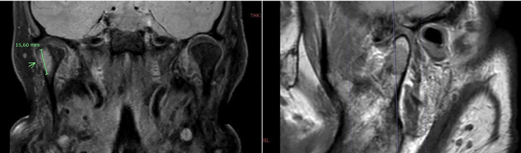 Metastasis of oncocytic thyroid carcinoma in the mandibular condyle: An exceptional localization.