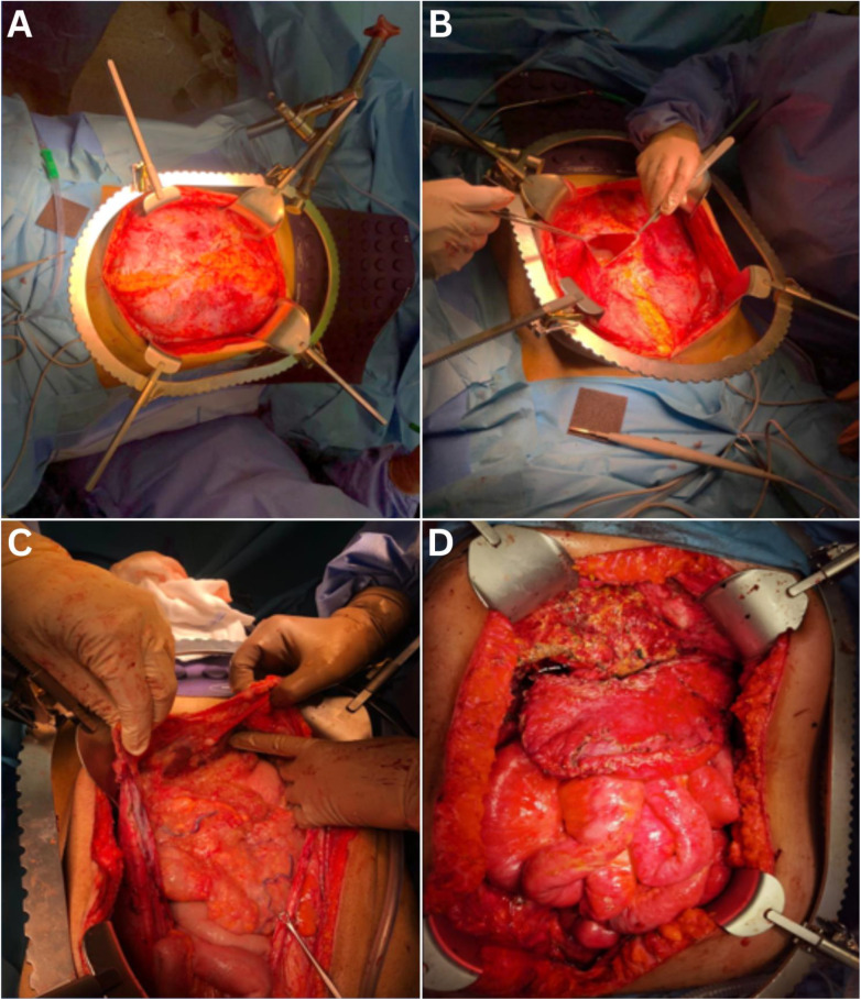 Pseudomyxoma Peritonei: <i>Exploring an unusual clinical presentation - A case report</i>.