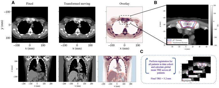 A unified workflow for classifying patterns of locoregional failure using radiotherapy treatment planning dose distributions.