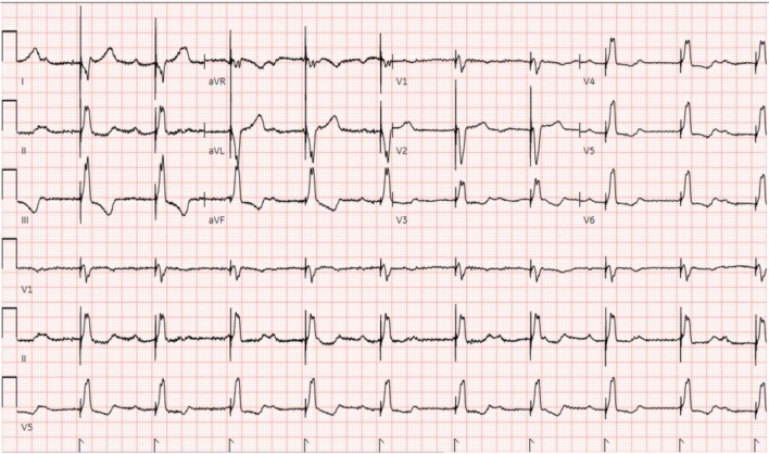Lacosamide-Induced Complete Heart Block in a Healthy Young Female.