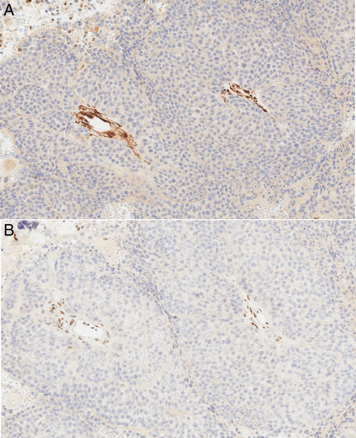 Pilomatrix-like High-grade Endometrioid Carcinoma of the Uterine Corpus With Excellent Response to Immune Checkpoint Inhibitor Therapy.