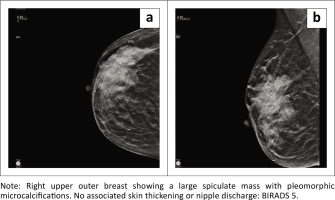 A review of papillary breast carcinoma in women attending a breast imaging centre in Johannesburg.
