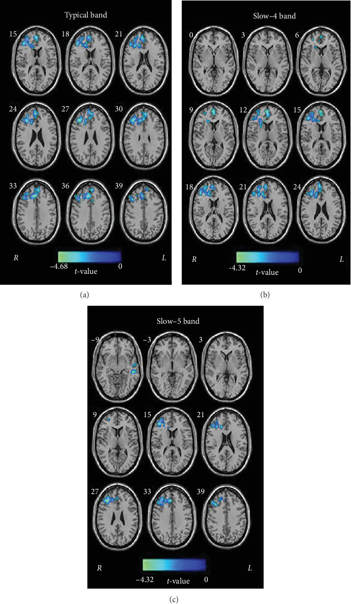 Percentage Amplitude of Fluctuation Alterations in Multiple Frequency Bands in Patients With Transient Ischemic Attack: A Resting-State fMRI Study.