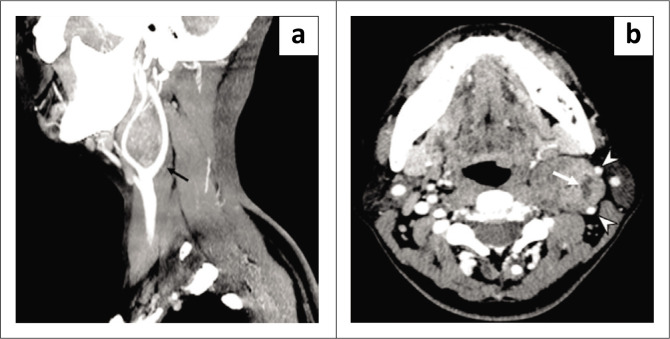 Lyre sign - Where schwannoma mimics a carotid body tumour.