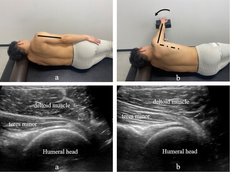 Effect of extension on stiffness of the teres minor muscle following extracorporeal shock wave therapy for frozen shoulder: a double-blind, randomized, controlled trial.
