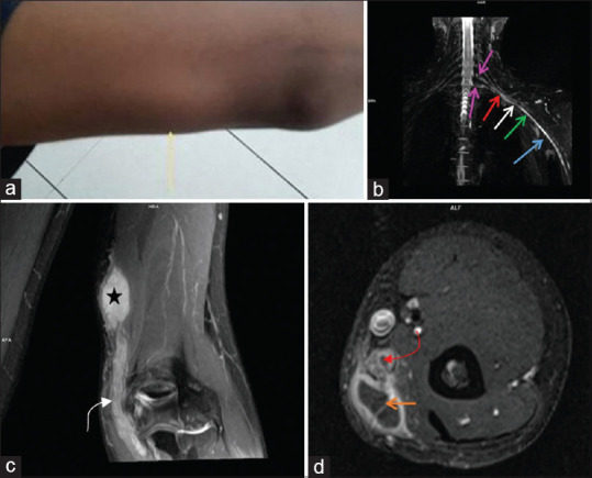 Utility of High-Resolution 3 T MR Neurography in Peripheral Nerve Pathologies.