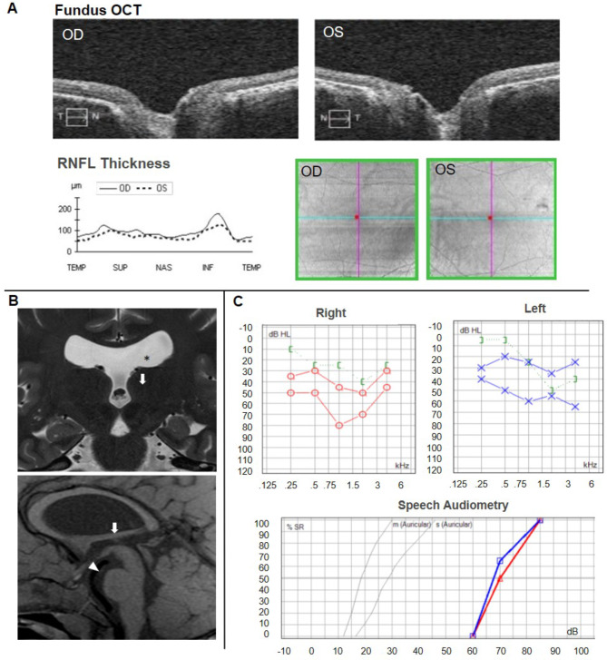 Two novel mutations in TBC1D32 add complexity to the oro-facial-digital syndrome.