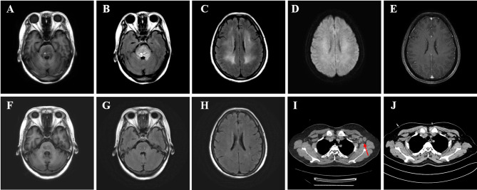 Human pegivirus detected in patient with reversible severe encephalitis and axillary lymphadenopathy: a case report.