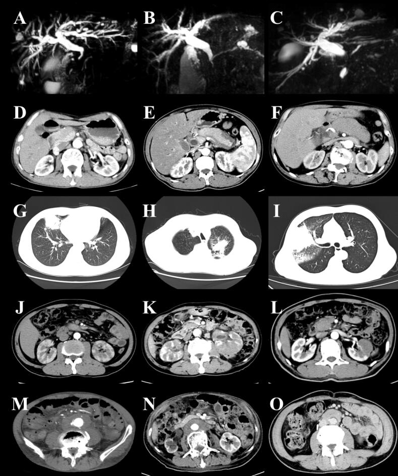Comparative Analysis of Clinical Characteristics in Multi-organ and Single-organ Involvement of IgG4-Related Disease: A Single-center Retrospective Study.