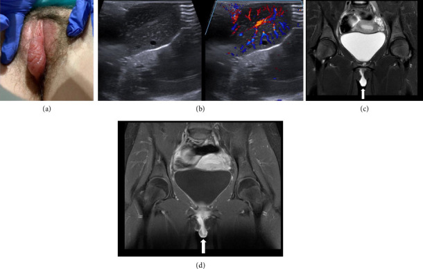 Adolescents With Labial Enlargement Misdiagnosed as Labial Masses on Imaging.