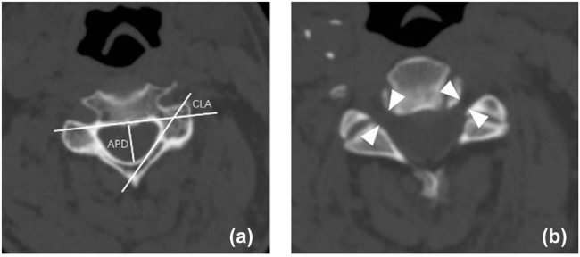 Cord-lamina angle and foraminal diameter as key predictors of C5 palsy after anterior cervical decompression and fusion surgery.