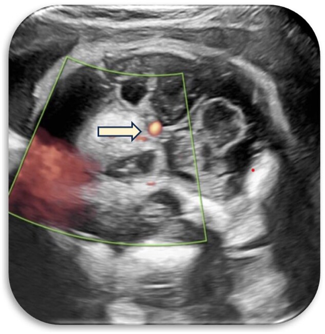 Unravelling fetal enigmas: a case of suprasellar lesion.