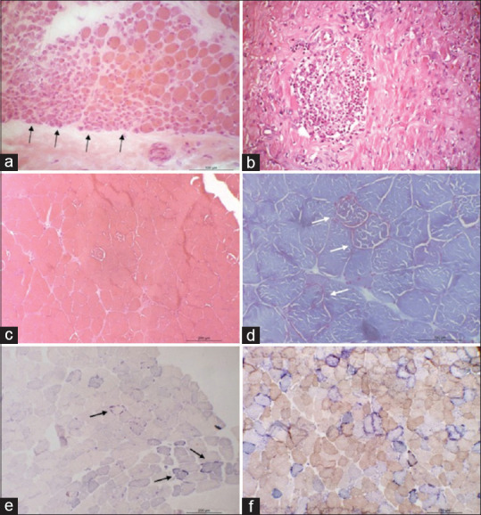 A Clinical Study on the Utility of Muscle Biopsy in Patients with Suspected Myopathy.