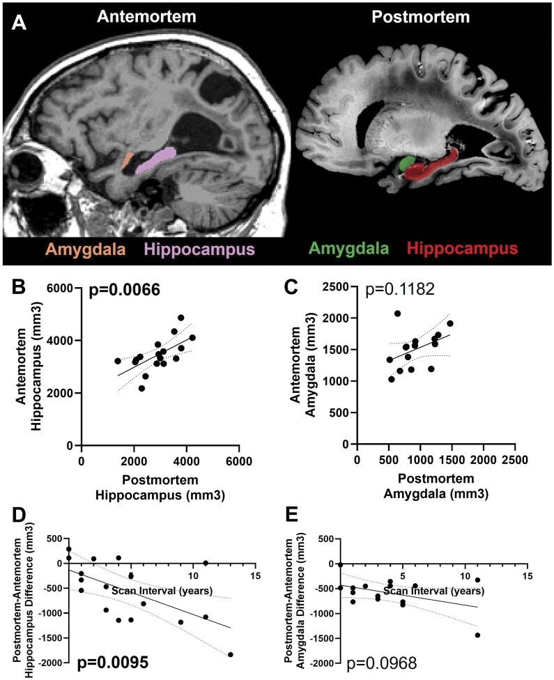 Correlating hippocampal and amygdala volumes with neuropathological burden in Down syndrome and Alzheimer's disease and related neurodegenerative pathologies using 7T postmortem MRI.